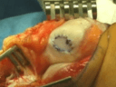  Autologous Chondrocyte Implantation for Treatment of Patellar Defect